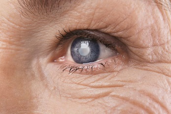 آیا پس از جراحی آب مروارید بینایی برمی گردد؟