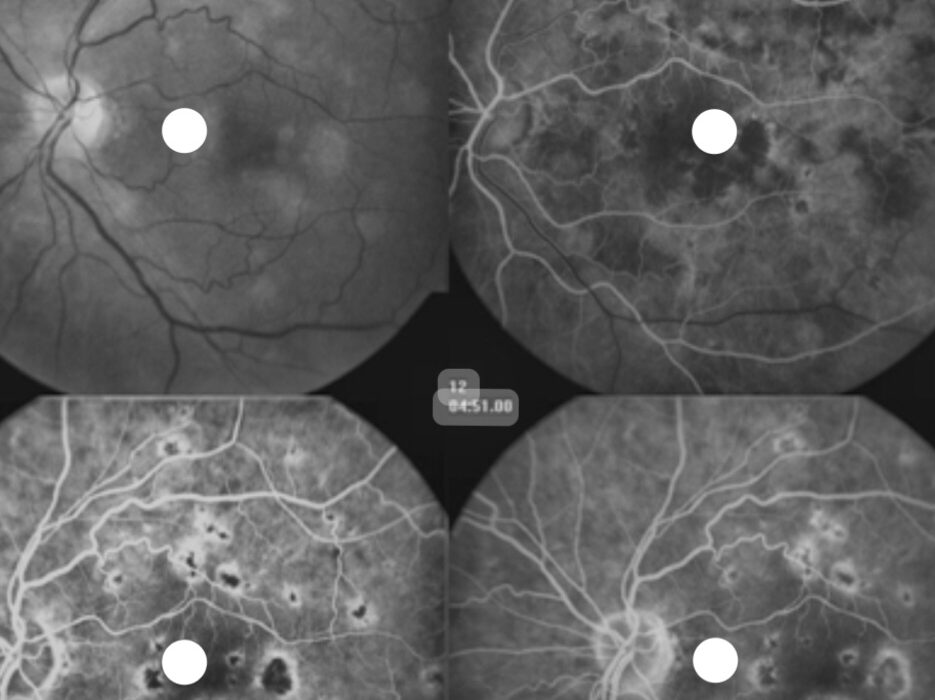 عوارض سومین عامل بیماری های چشمی