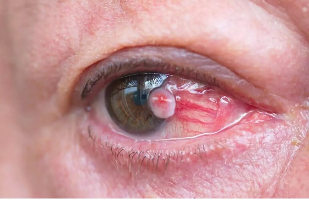 اهمیت تشخیص زودهنگام تومور چشم در کودکان زیر ۵ سال / شایع‌ترین علائم رتینوبلاستوما