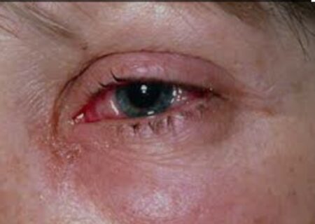 دو بیماری چشم که با خطر نابینایی همراه است / توصیه به دیابتی‌ها و سالمندان