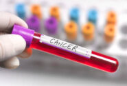 چرا برخی سرطان‌ها بعد از درمان عود می‌کنند؟